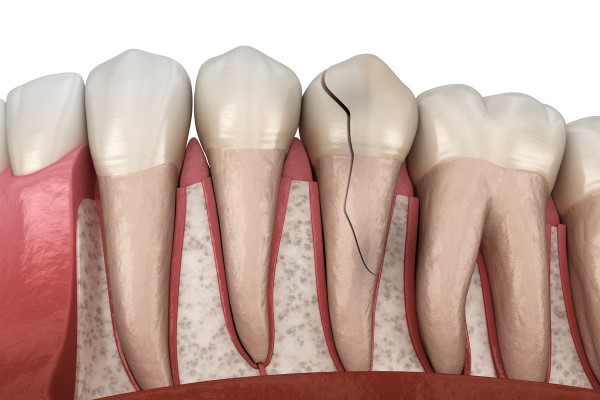 Can A Broken Tooth Be Saved?