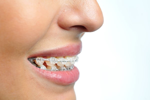 How Long Does Treatment With Clear Braces Normally Take?