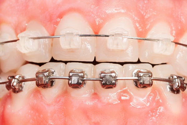 Do Clear Braces Work? Everything to Know for New Users