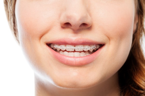 Proper Care For Clear Braces