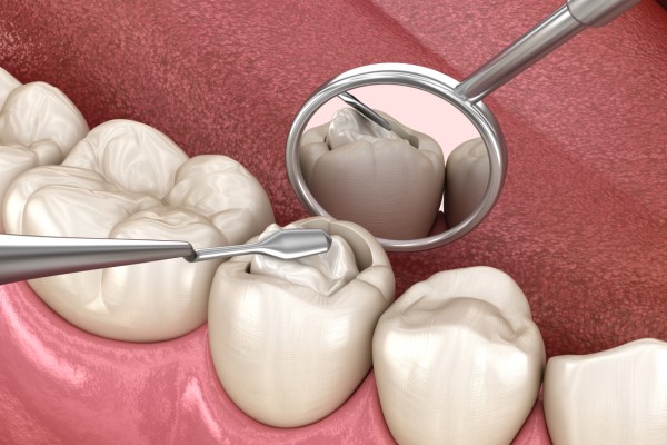 Dental Filling - How Long Does it Take to Fill a Cavity