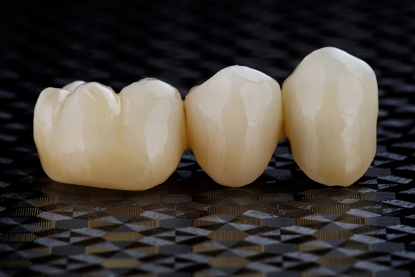 Understanding The Process For Dental Bridges