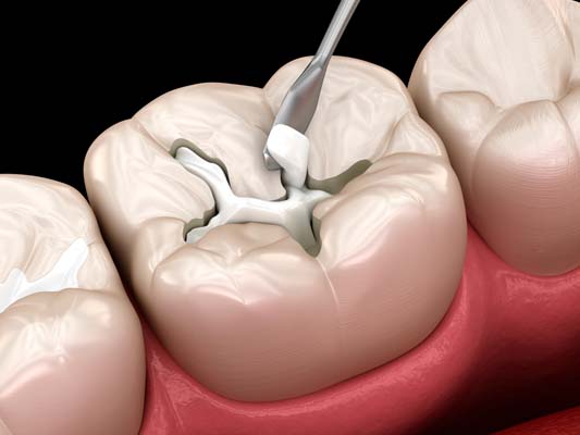 Common Misconceptions About Dental Fillings