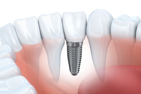 Guide To Dental Implant Procedure Steps