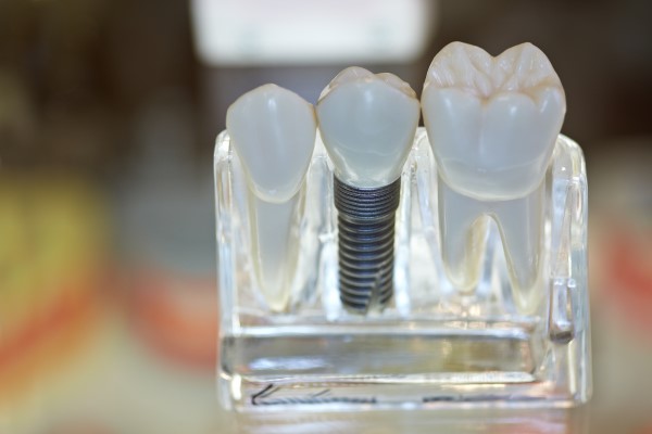 Dental Implants Ashburn, VA