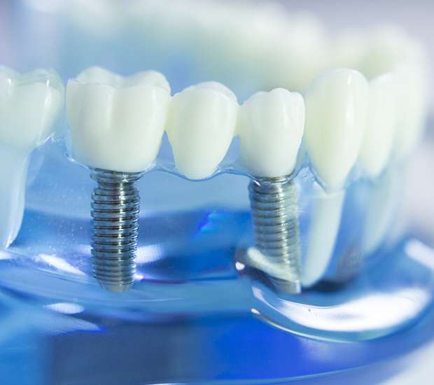 Ashburn Dental Implants