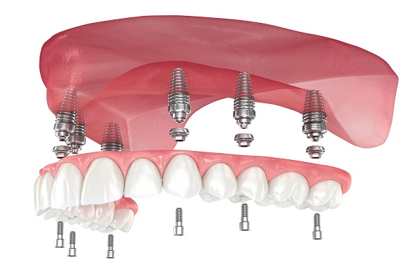 Tips To Extend The Longevity Of Implant Supported Dentures