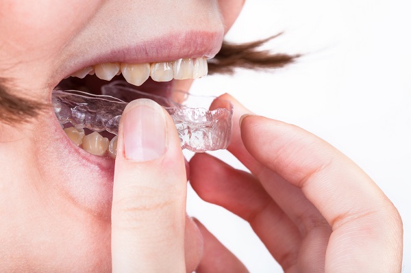 Invisalign Dentist Ashburn, VA