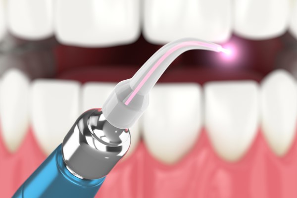 The Treatment Process From A LANAP Laser Dentist